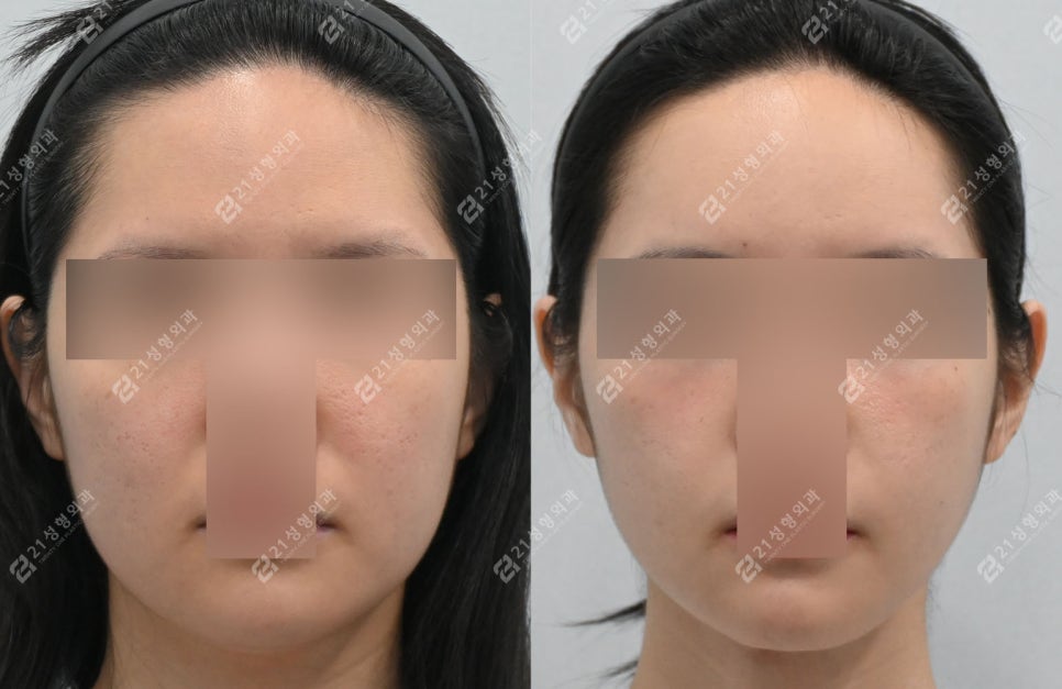 Double Chin Surgery, There Was Actually Another Cause (Real Case Analysis) image 6