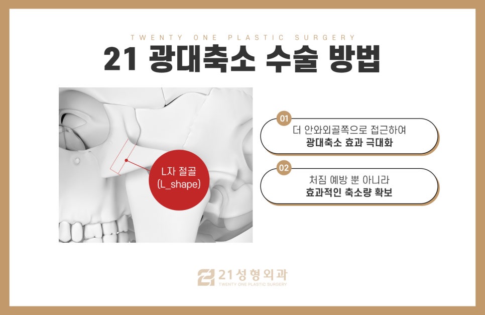 남자광대축소술 울퉁불퉁한 라인을 매끄럽게 관련 이미지 5