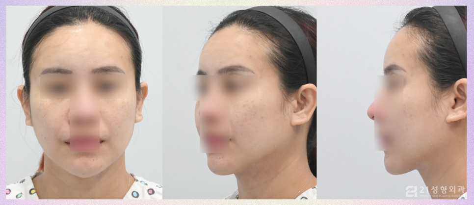 투턱지방흡입 이중턱없는 매끈한 턱 라인이 필요할 때 관련 이미지 7