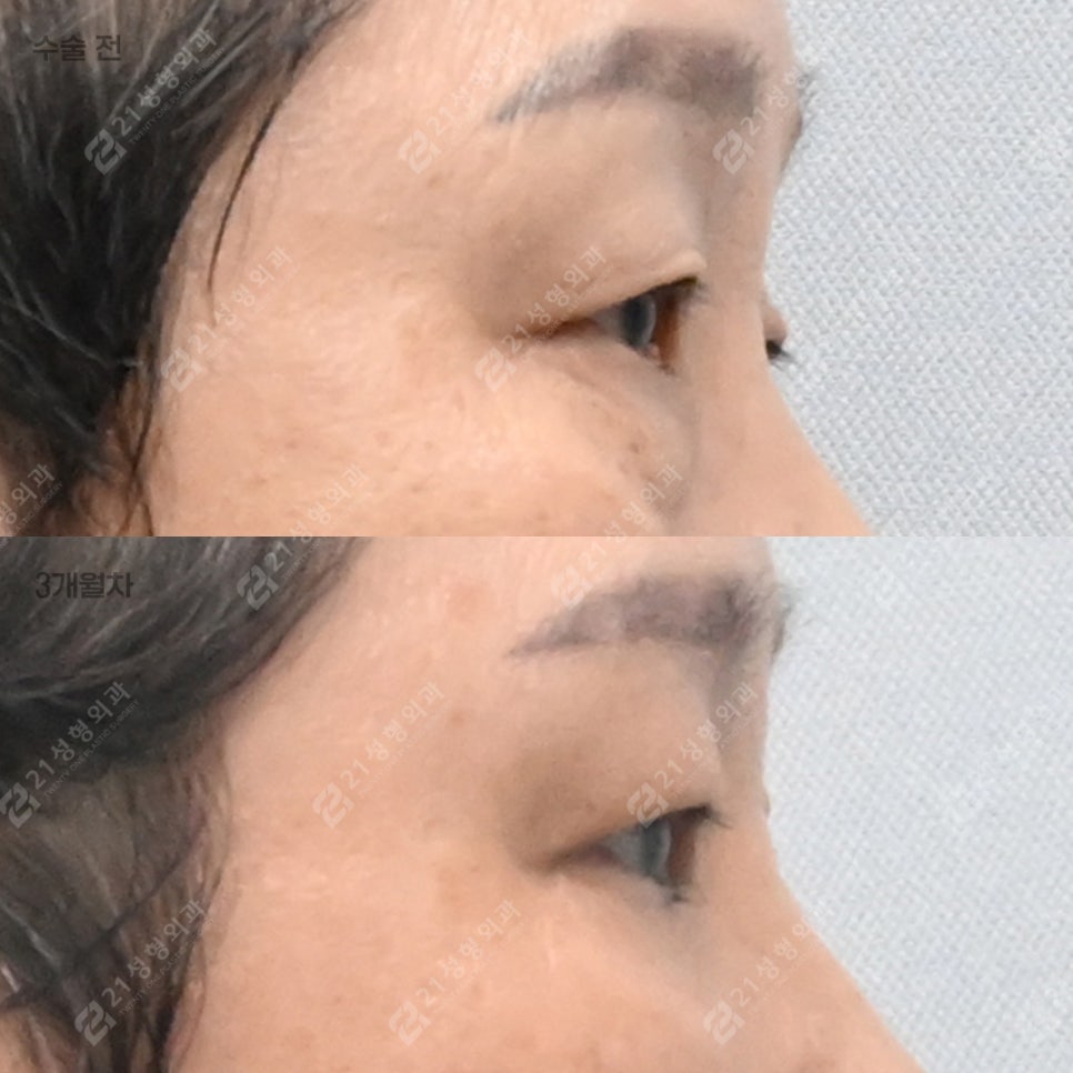 Do Your Eyes Feel Heavy and Constricted? 21 Plastic Surgery Explains How to Self-Assess for a Sub-Brow Lift image 4