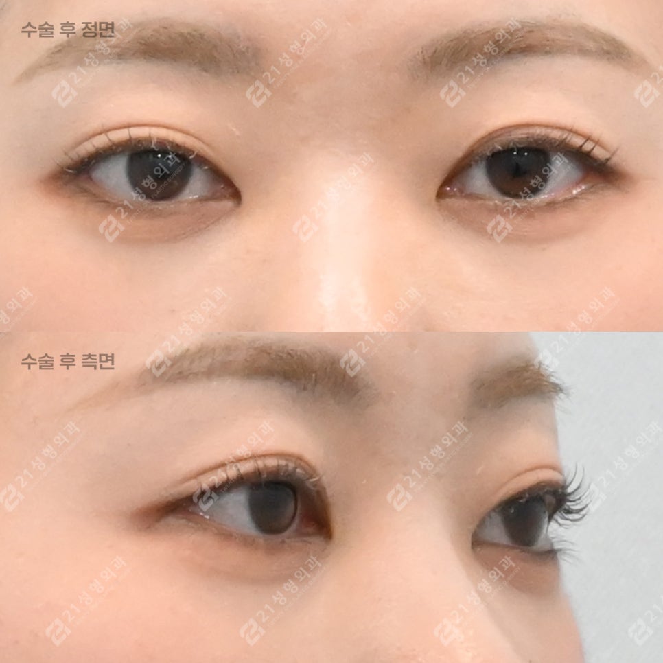 눈밑지방재배치를 받았는데 애교살이 없어졌어요 관련 이미지 5