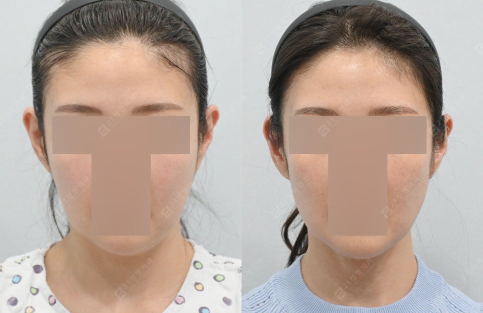 Real Review: A Smooth Improvement of Leftover Double Chin and Jowl Fat Even After Dieting image 7