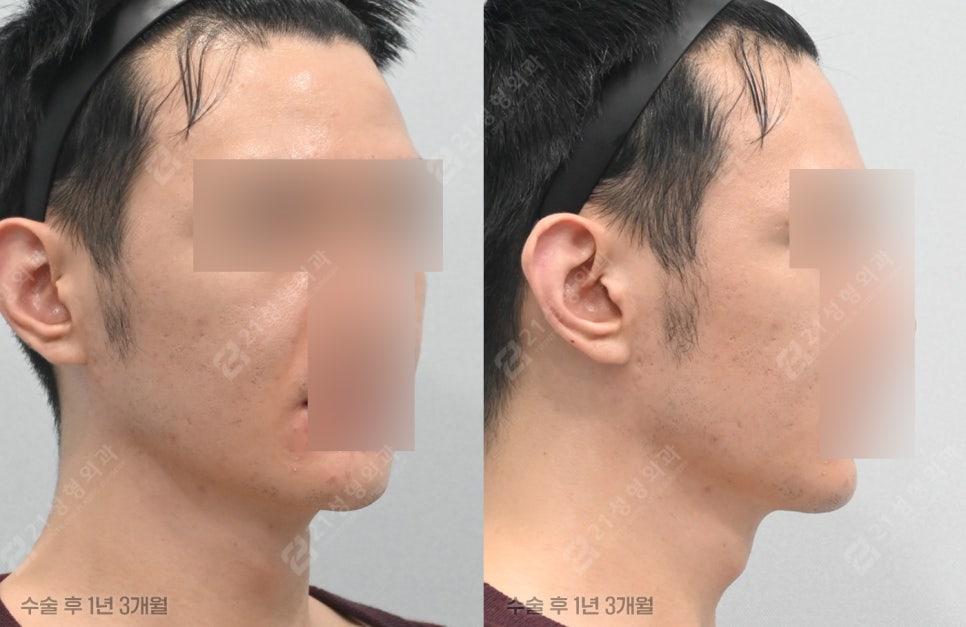 Have You Regretted Having Only Double-Chin Liposuction? Why Muscle Tightening May Be Needed for Successful Double-Chin Surgery image 7
