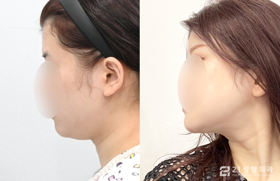 안면윤곽3종 달라지는 라인의 비결 관련 이미지 3