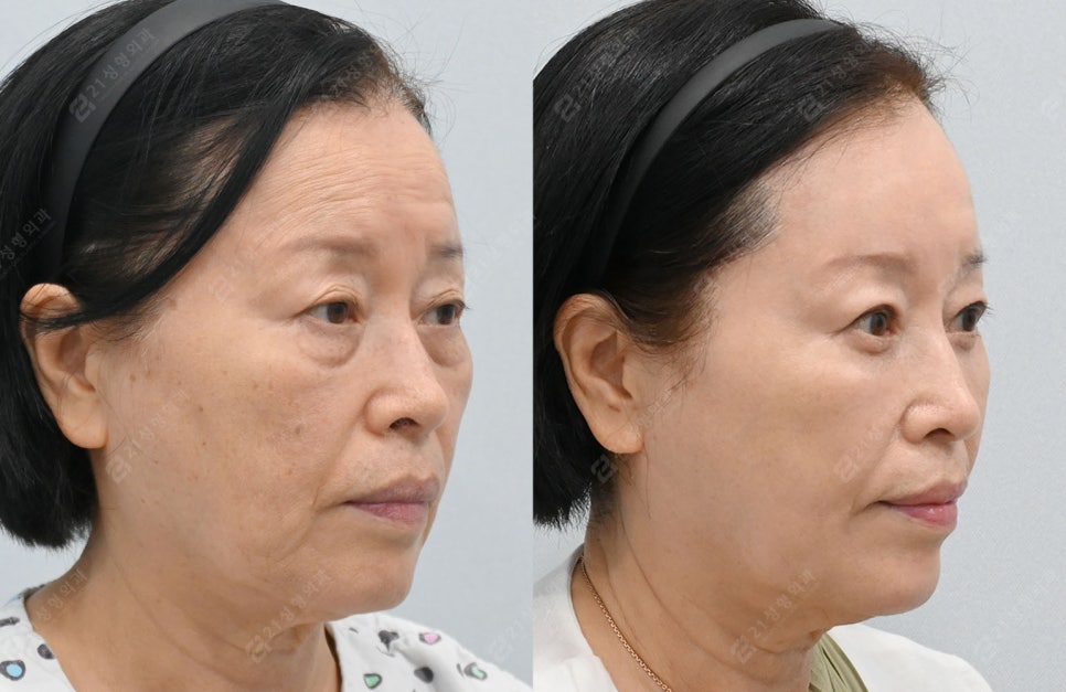 자연스럽게 젊어지고 싶다면? 중년 수술 이마거상, 상.하안검으로 해결! 관련 이미지 7