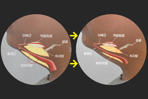 이중턱, 만져보면 원인이 보입니다 -21성형외과가 4가지로 나누는 이유 관련 이미지 4