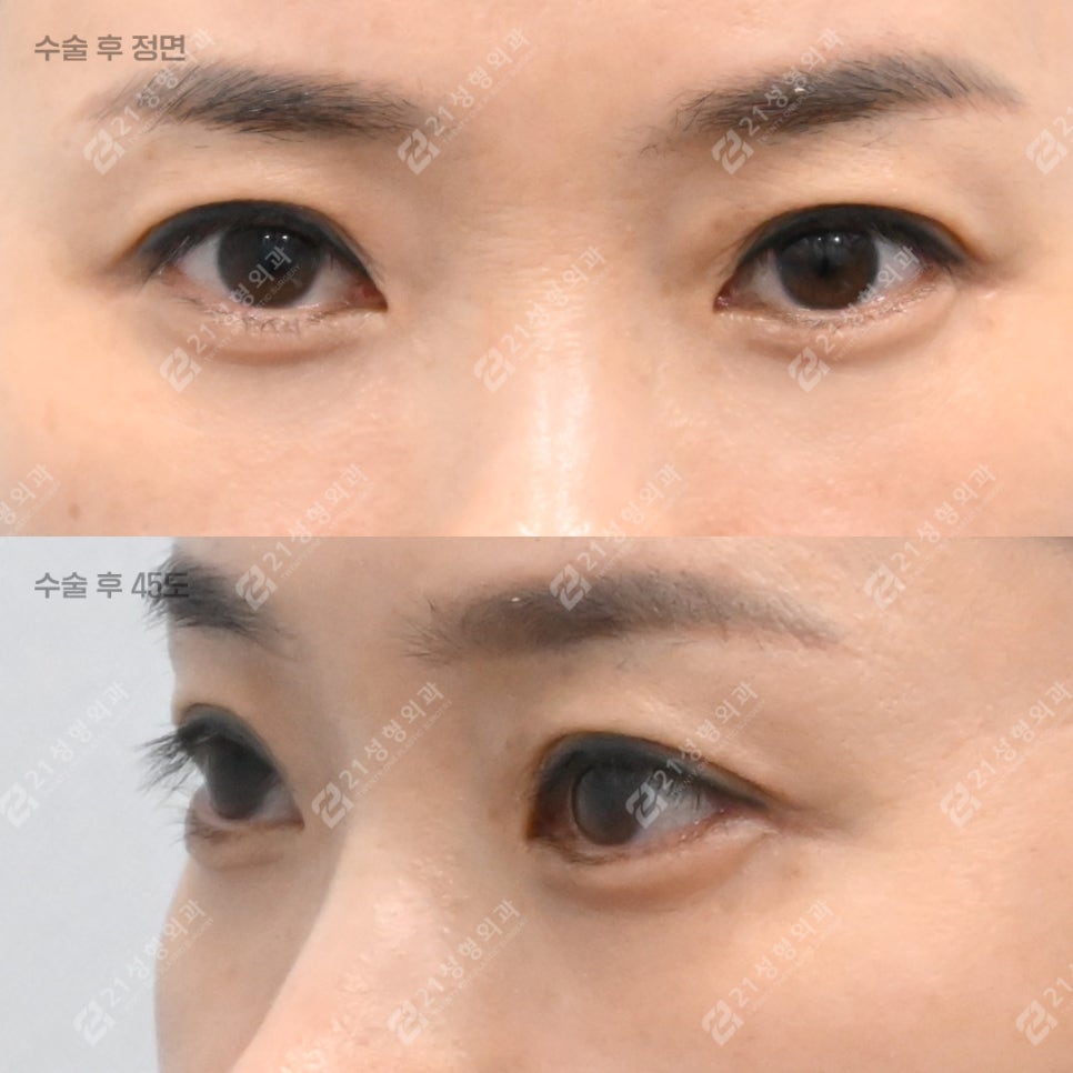 상담할 때 눈밑 피부를 먼저 확인하는 이유 관련 이미지 5