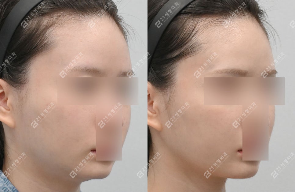 The Reason a Double Chin Appeared After Surgery Was Not a Fat Problem image 7