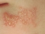 [항 바이러스제] herpes virus (헤르페스 바이러스) ② 관련 이미지 6