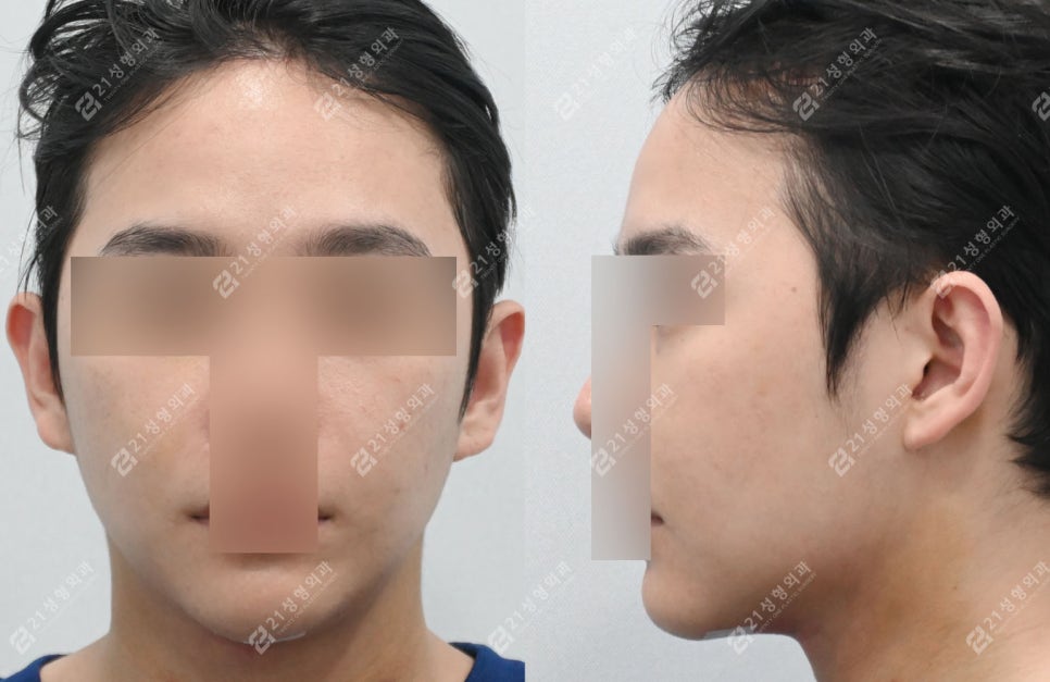 살은 안 쪘는데 왜 이중턱만 남을까? 남자 이중턱의 진짜 원인 관련 이미지 2