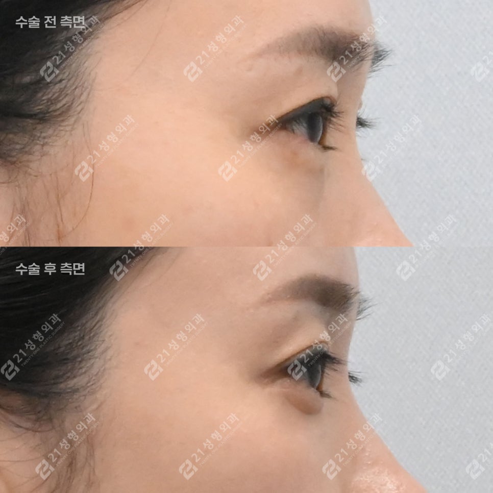 피곤해 보이던 40대 눈밑, 하안검 후 이렇게 달라졌습니다 관련 이미지 6