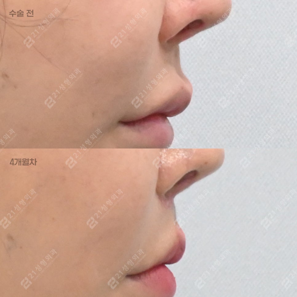 Why More People Are Seeking Philtrum Reduction Recently &ndash; 21성형외과 image 2