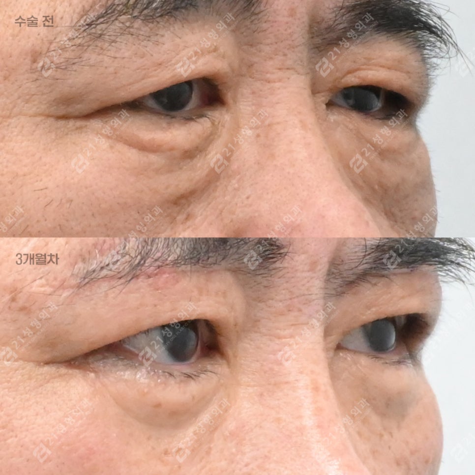 눈밑 처짐으로 인상이 무너지기 전에, 21성형외과 남성 하안검 관련 이미지 2