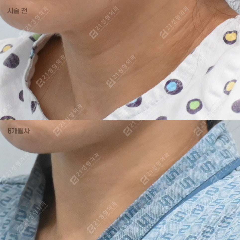 That Posture You Use While Looking at Your Smartphone—Half of Your Neck Wrinkles Start There. — 21 Plastic Surgery Neck Wrinkle Treatment image 3
