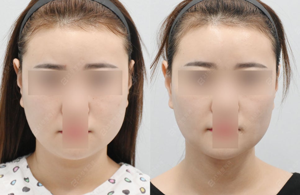 이중턱, 지방만 빼면 끝? 진짜 해결 방법과 실제 환자 전후 비교 관련 이미지 5