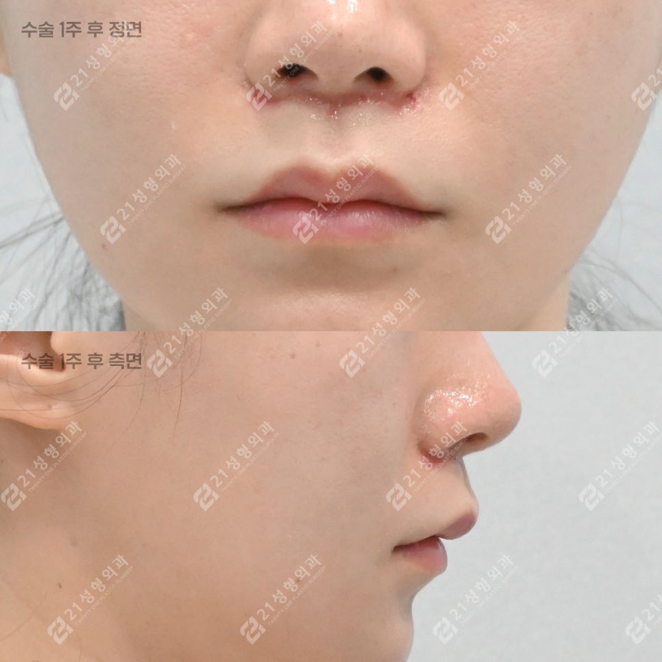 Lip Lift Review | What Matters More Than Length Is Facial Proportion! image 3
