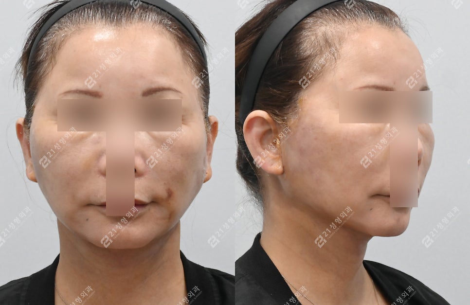 Mid-Face Lift Revision Surgery Case in a Patient in Their 60s image 3