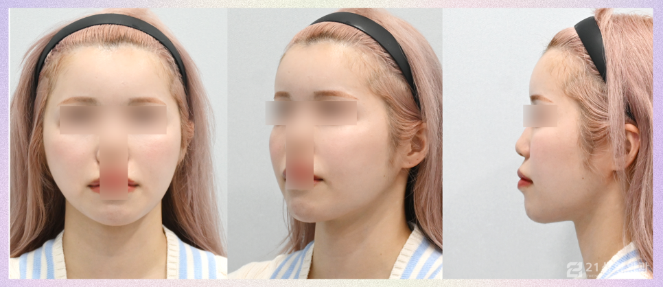 얼굴지방이식잘하는곳 노하우가 궁금하다면 관련 이미지 6