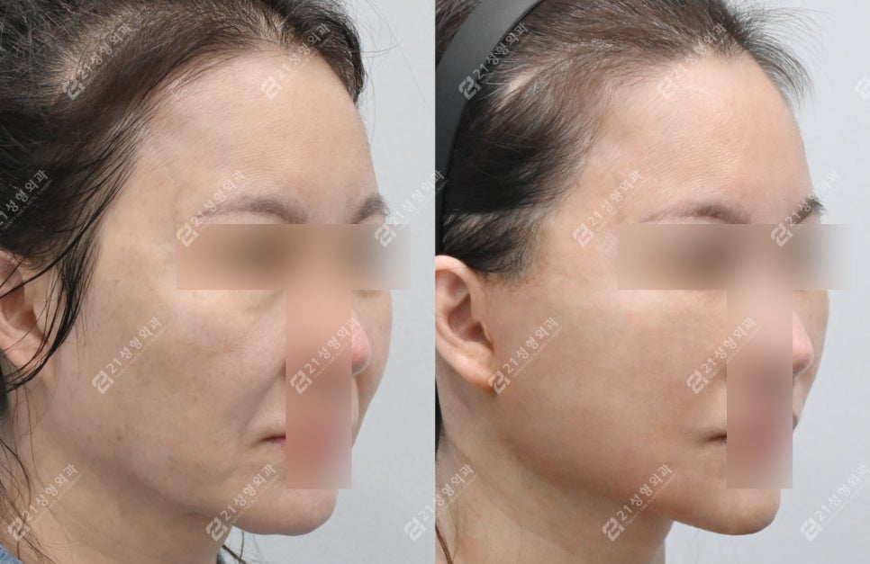 21성형외과에 사연을 들려주세요 두번째 이야기(안면거상/이중턱) 관련 이미지 3