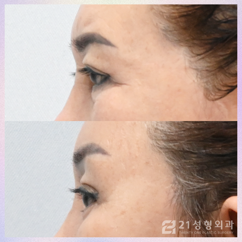상안검수술회복기간 제대로 알아보기 위해서는 관련 이미지 3