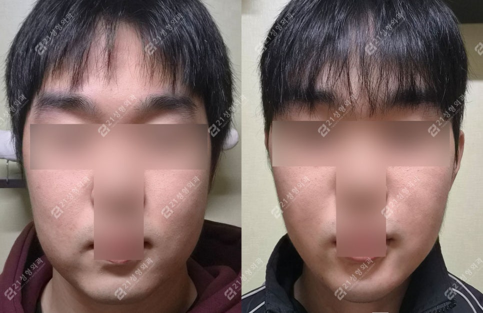 Male Double Chin + Chin Advancement Surgery Real Case: Why the Mood and Impression Change image 4