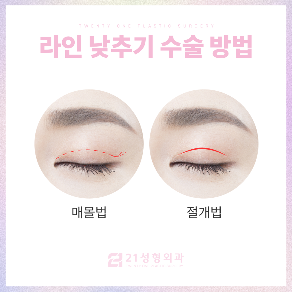 강남역쌍커풀수술 티 나지 않는 자연스러움 관련 이미지 4