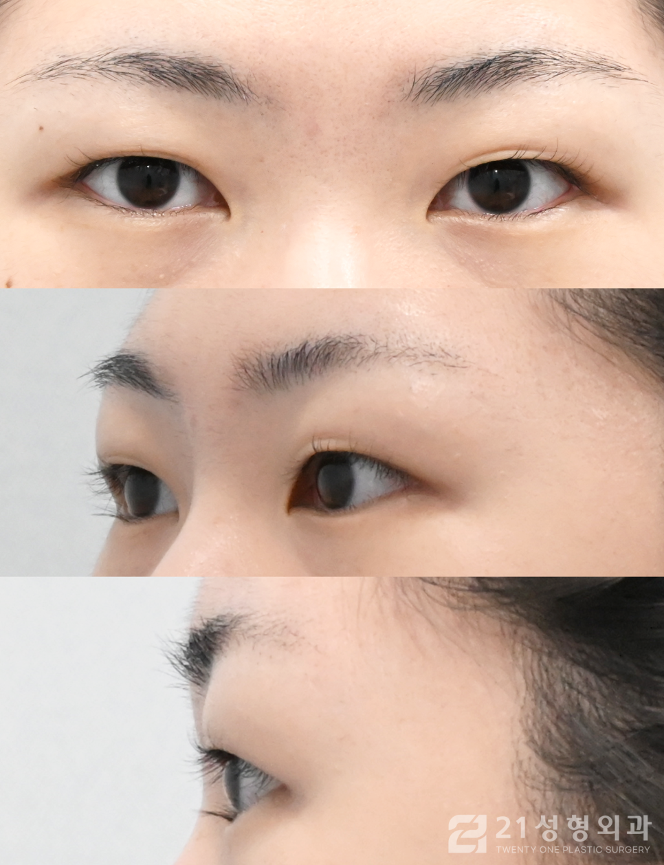 눈매교정병원 자연스러운 눈의 차이 관련 이미지 4