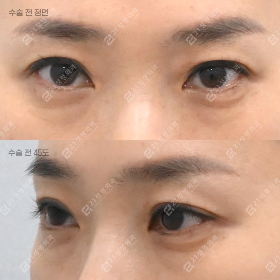상담할 때 눈밑 피부를 먼저 확인하는 이유 관련 이미지 4