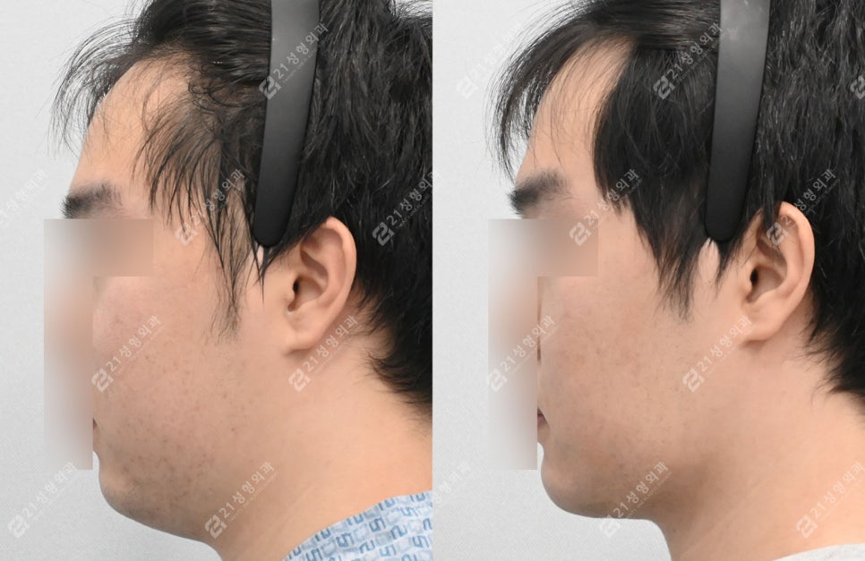 Male Double Chin + Chin Advancement Surgery Real Case: Why the Mood and Impression Change image 8
