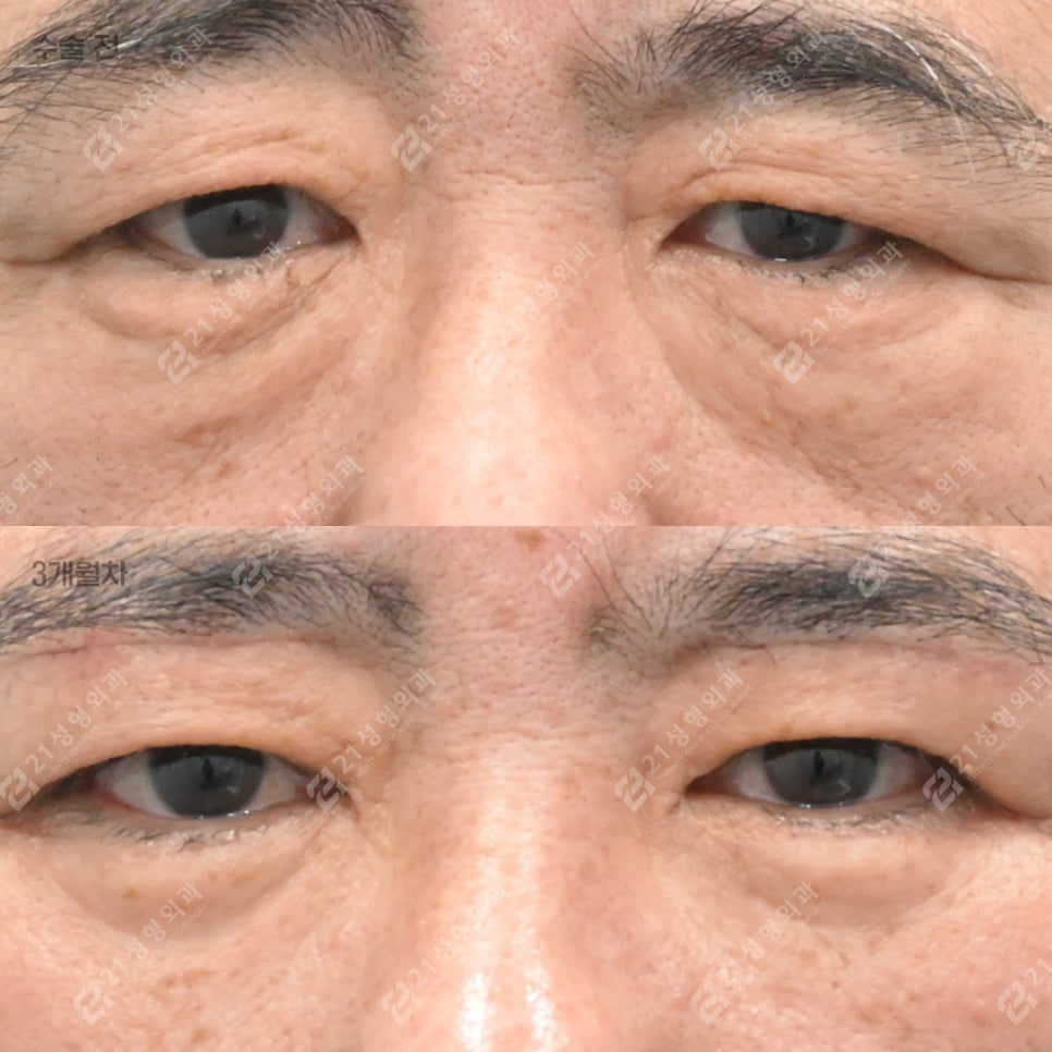 눈밑 처짐으로 인상이 무너지기 전에, 21성형외과 남성 하안검 관련 이미지 1