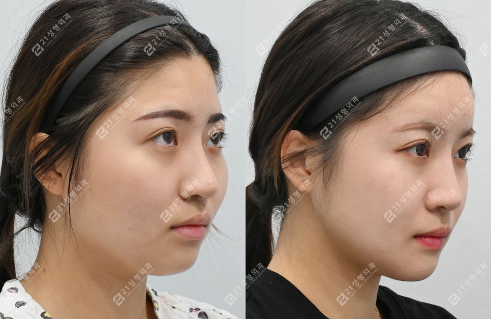Real Review of Square Jaw Surgery: Square Jaw Surgery Is Not Over After Just Shaving the Bone image 11