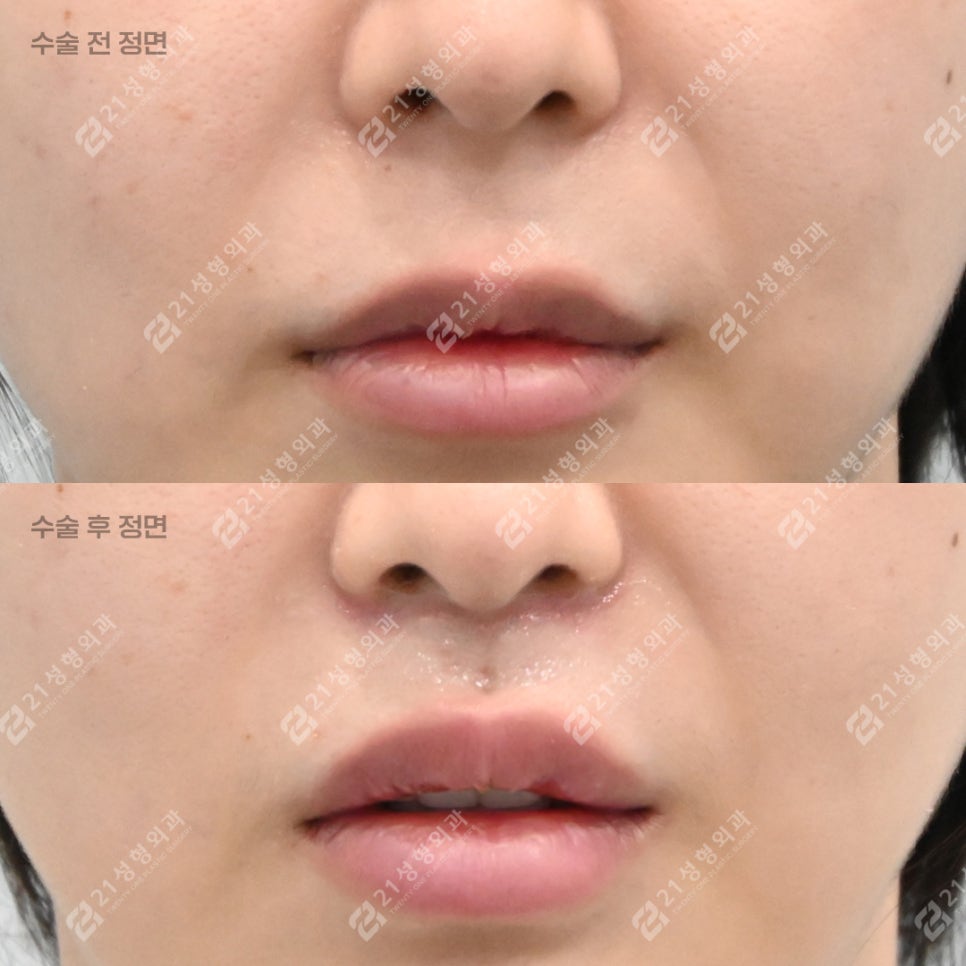 How to Make the Philtrum Look Shorter by Adding Dimension Alongside Philtrum Reduction Surgery image 1