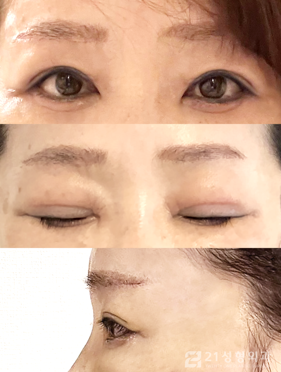 강남눈수술잘하는곳 찾아보고 있다면 관련 이미지 5