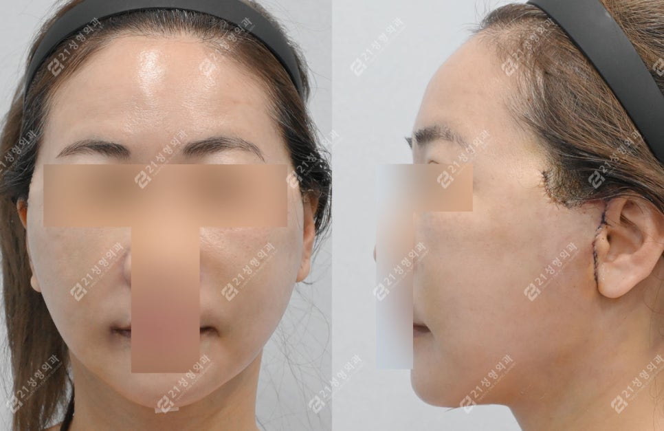 Facial and Neck Lift: The Key Is Structure, Not Skin | Real Before-and-After Review image 3