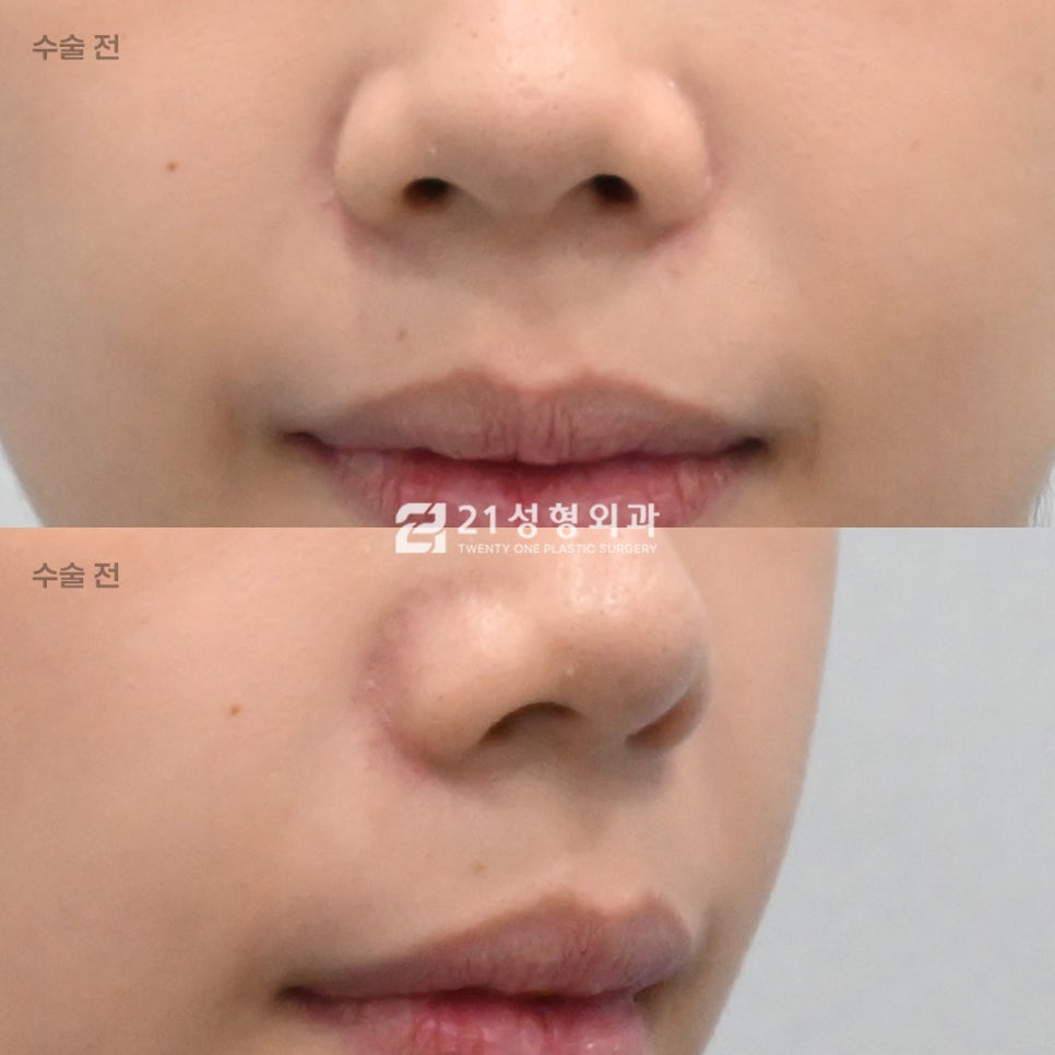 인중 흉터 없이 짧아 보이는 법? 성형외과 원장이 밝히는 인중 라인 착시 효과 관련 이미지 4