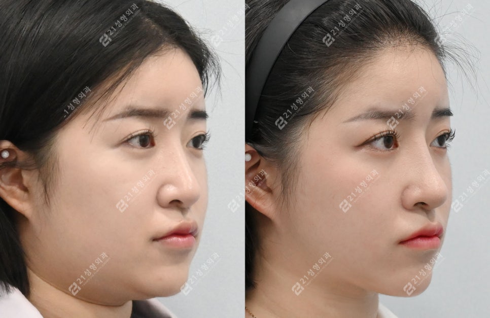 코성형 후 인상이 달라진 이유, 얼굴 중심의 차이 관련 이미지 7