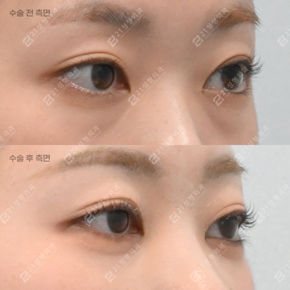 눈밑지방재배치를 받았는데 애교살이 없어졌어요 관련 이미지 2