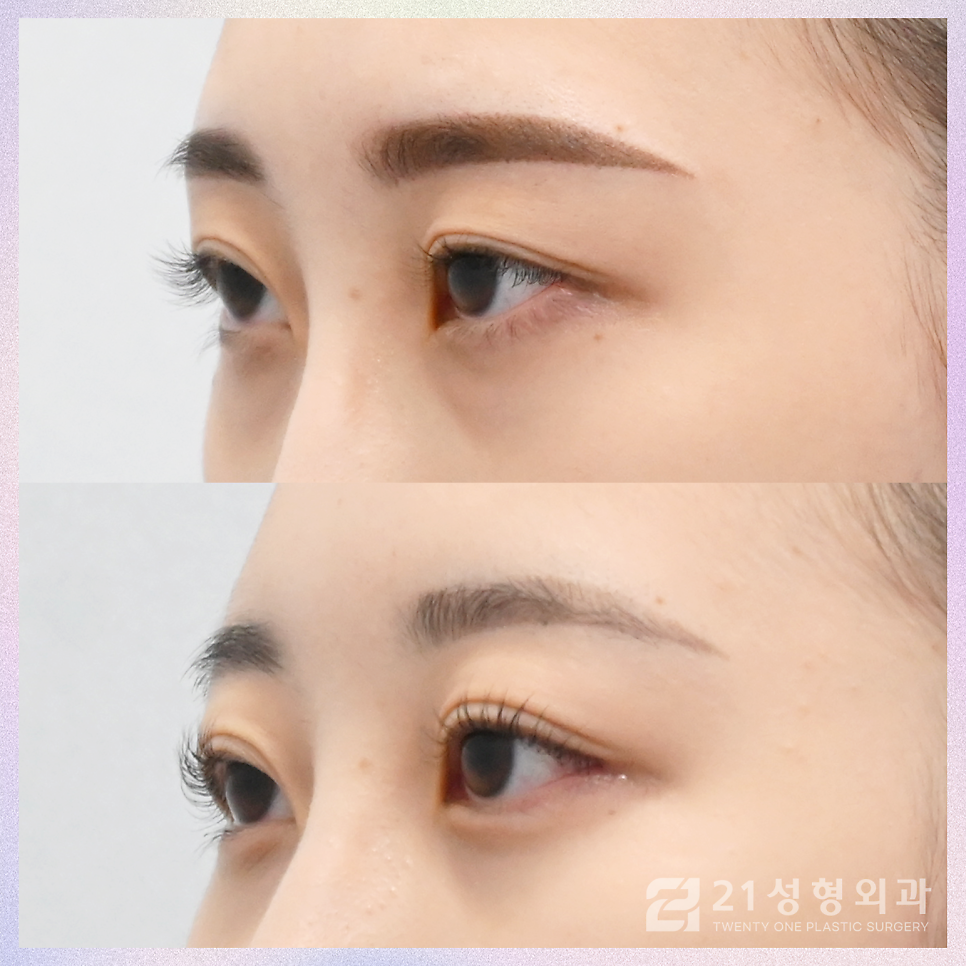 눈트임성형으로 크고 선명하게 관련 이미지 2