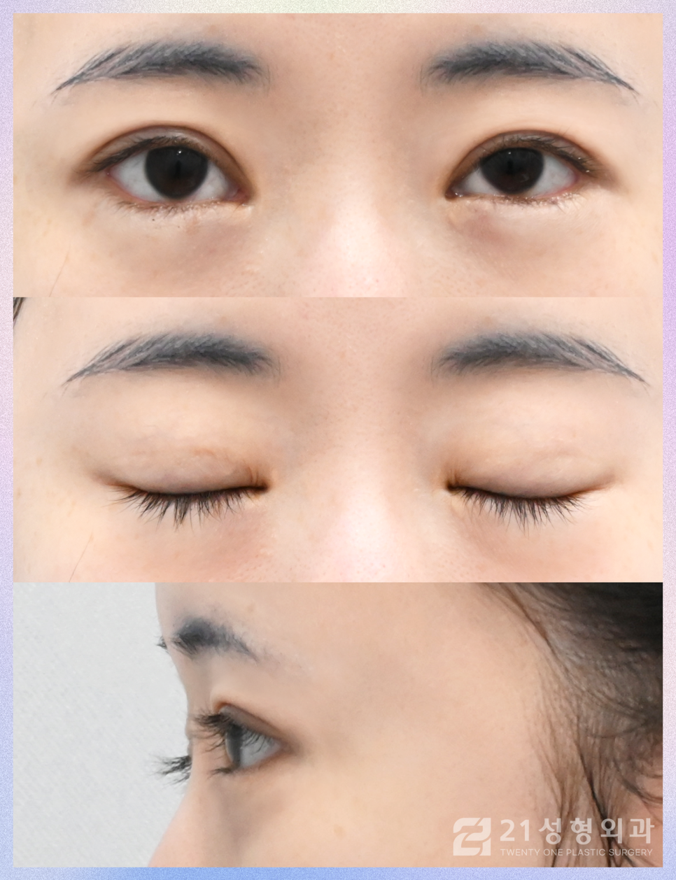 눈밑지방재배치수술잘하는곳 21성형외과에서 관련 이미지 6