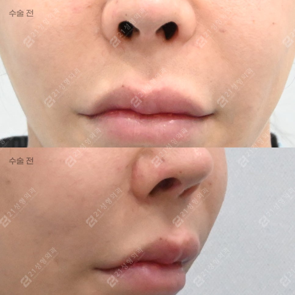 Why More People Are Seeking Philtrum Reduction Recently &ndash; 21성형외과 image 5