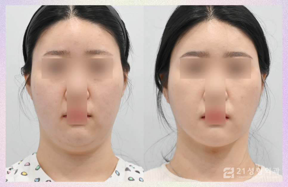 이중턱빼는방법을 찾고 있다면 관련 이미지 1