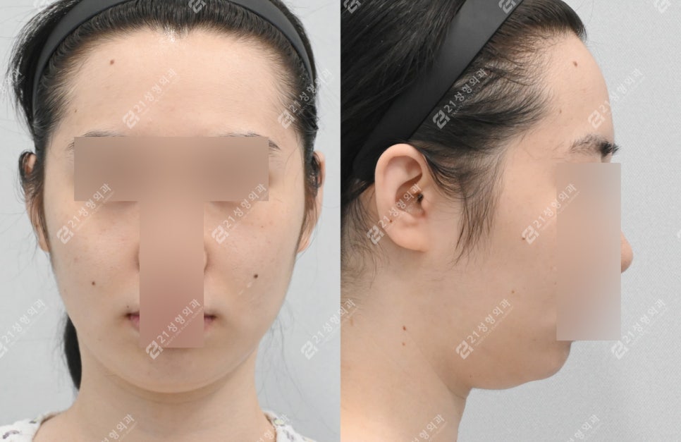턱끝성형 : 턱끝전진술+이중턱근육묶기 실제 환자 리뷰 관련 이미지 3
