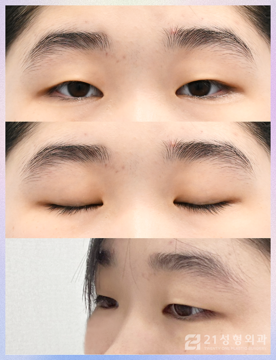 쌍꺼풀절개수술 안검하수를 효과적으로 개선하는 방법 관련 이미지 5