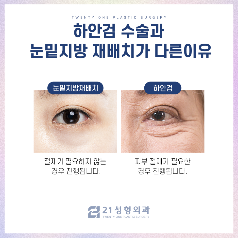 강남하안검수술 처짐 없는 동안 눈매를 위해 관련 이미지 4