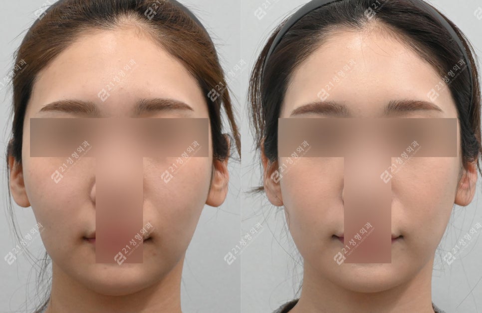 Before and After Cheekbone Reduction: Changes in Facial Width (4 Months · 1 Year) image 1