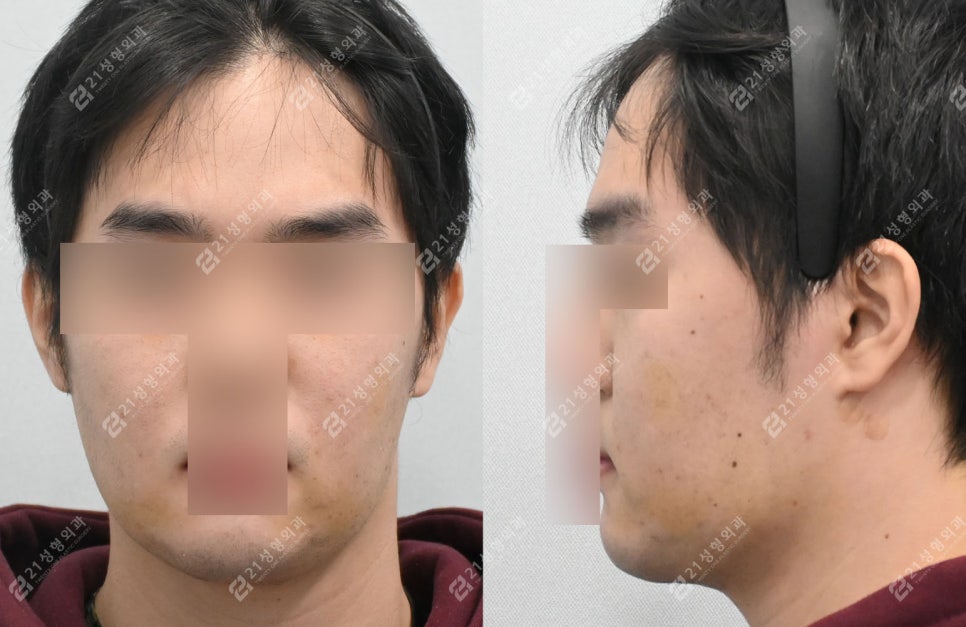 Male Double Chin + Chin Advancement Surgery Real Case: Why the Mood and Impression Change image 5