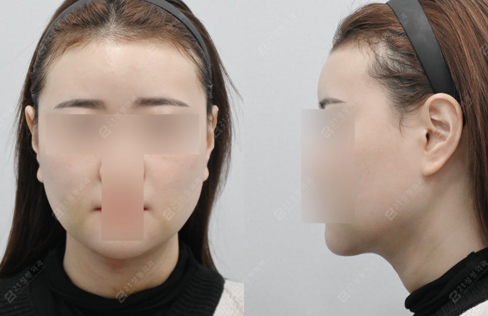 이중턱, 지방만 빼면 끝? 진짜 해결 방법과 실제 환자 전후 비교 관련 이미지 3