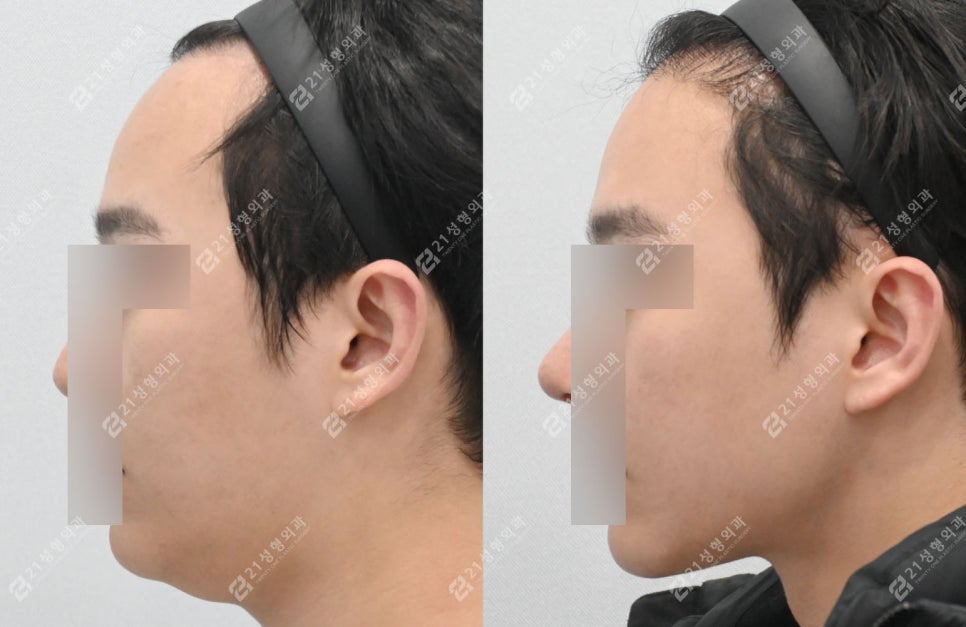 살은 안 쪘는데 왜 이중턱만 남을까? 남자 이중턱의 진짜 원인 관련 이미지 7