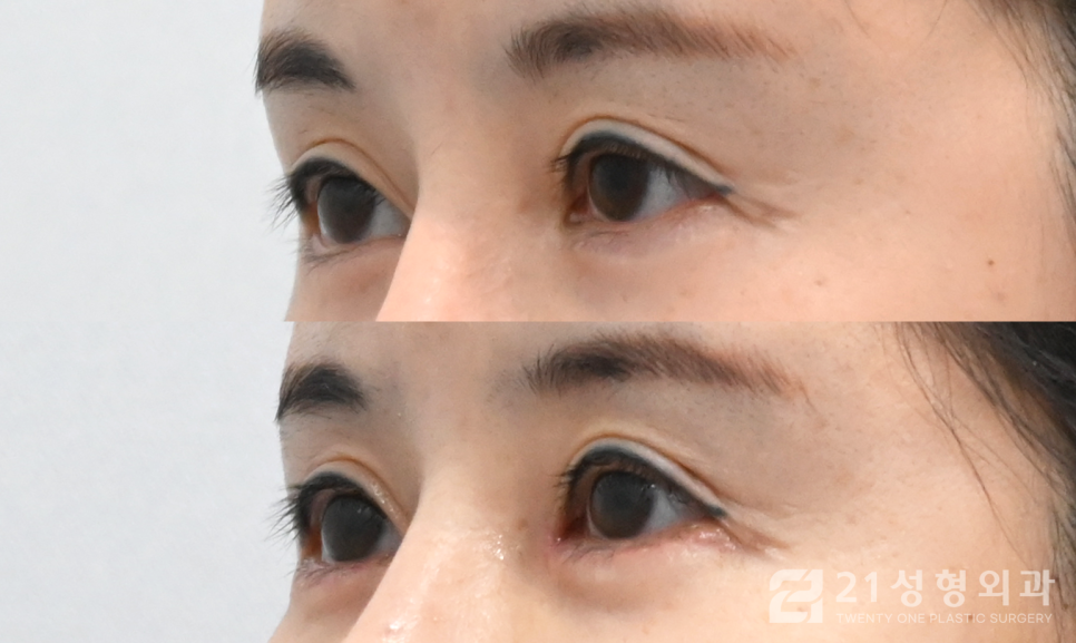 앞트임복원성형외과 잘하는 곳의 특징 관련 이미지 3