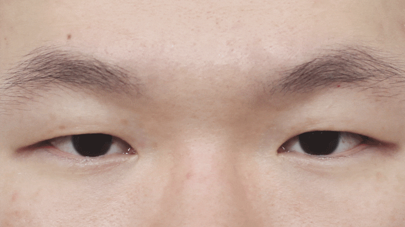 [눈 성형] 낮은 쌍꺼풀 높이기~ 관련 이미지 5